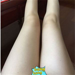 保定市第五醫(yī)院美容整形科做大腿吸脂怎么樣？附劉根立醫(yī)生案例效果圖