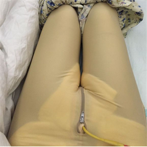 保定市第五醫(yī)院美容整形科做大腿吸脂怎么樣？附劉根立醫(yī)生案例效果圖