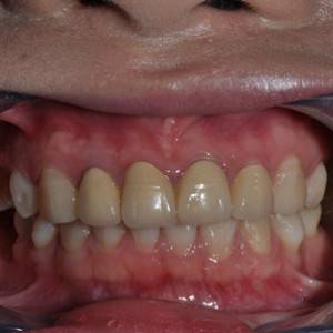 保定東陽口腔醫(yī)院張亞靜醫(yī)生做牙齒冷光美白怎么樣？附冷光美白案例效果對(duì)比圖