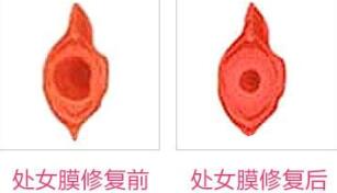 蚌埠市第三人民醫(yī)院燒傷整形科許瑾醫(yī)生做處女摸修復怎么樣？附案例