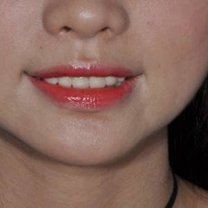 保定東陽口腔醫(yī)院張亞靜醫(yī)生做牙齒冷光美白怎么樣？附冷光美白案例效果對比圖