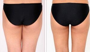 蚌埠市第三人民醫(yī)院燒傷整形科徐衛(wèi)東醫(yī)生做臀部吸脂效果怎么樣？