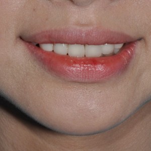 保定東陽口腔醫(yī)院張亞靜醫(yī)生做牙齒冷光美白怎么樣？附冷光美白案例效果對(duì)比圖