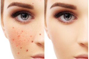 激光祛斑的一般價(jià)格是多少？