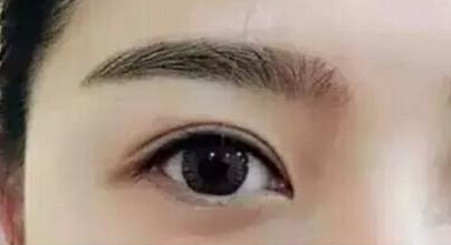 切開(kāi)雙眼皮需要多久能恢復(fù)？手術(shù)后會(huì)留疤嗎？