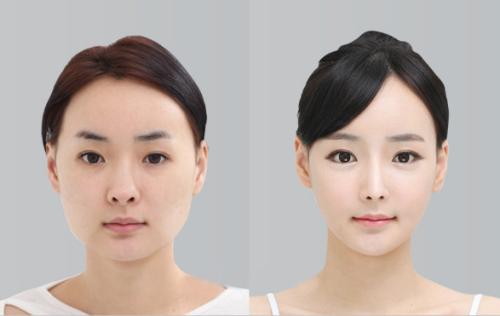 想做歐式雙眼皮，什么是歐式雙眼皮？