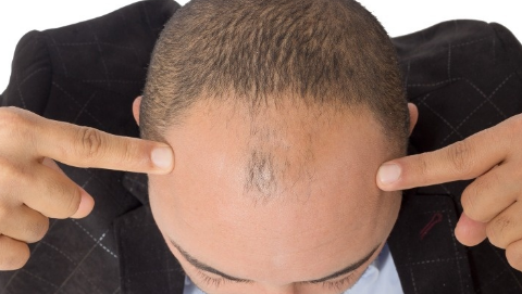 頭發(fā)種植后還會脫落嗎？