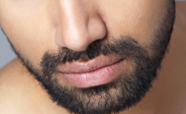 激光脫胡子多久脫一次？激光去胡子大概多少錢一次？