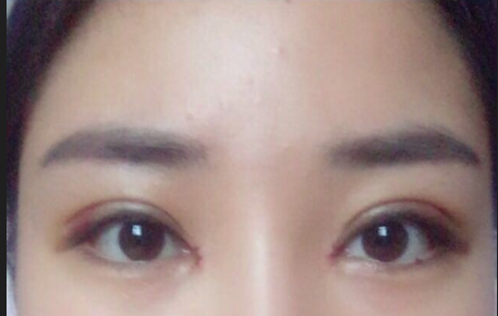 全切雙眼皮多少錢一次？全切雙眼皮后遺癥有哪些？