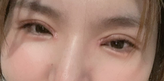 全切雙眼皮多久能恢復(fù)正常？