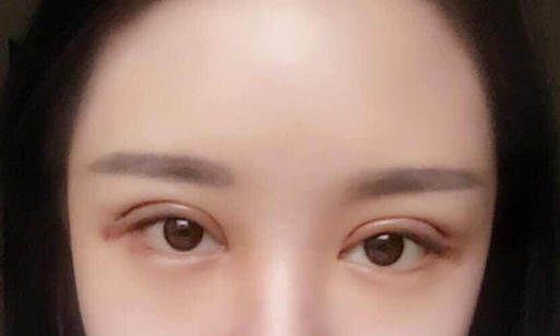 全切雙眼皮手術(shù)多少錢一次？
