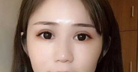 全切雙眼皮會越來越窄嗎？全切雙眼皮消腫的辦法有哪些？