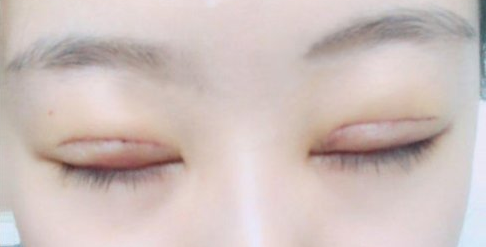 做全切雙眼皮能維持多久？全切雙眼皮多長時間能恢復(fù)？