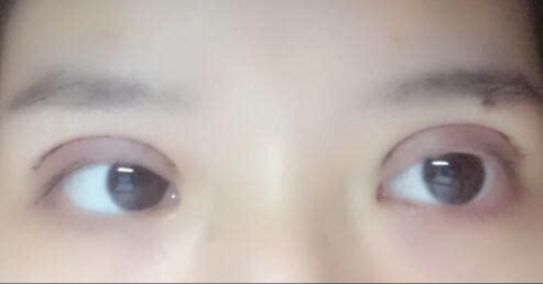 全切雙眼皮手術(shù)優(yōu)勢？