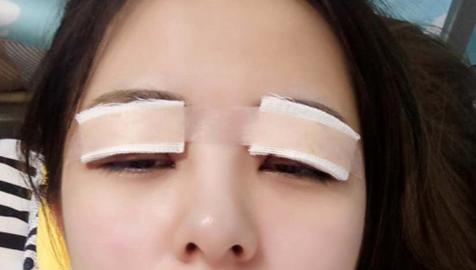 全切雙眼皮怎么恢復快？