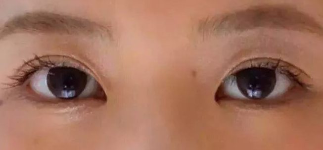 全切雙眼皮術(shù)后會(huì)疼幾天？