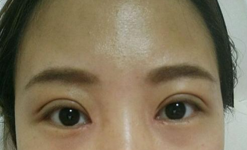 全切雙眼皮術(shù)后會留疤嗎？