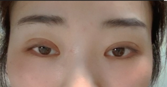 什么是全切雙眼皮？全切雙眼皮的恢復(fù)時間？