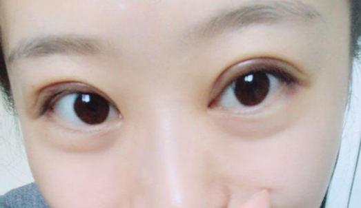 全切雙眼皮術(shù)后會(huì)反彈嗎？