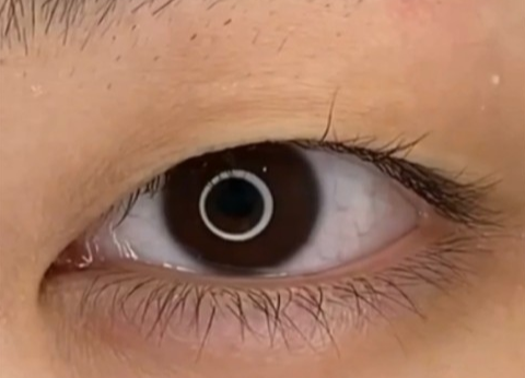 全切雙眼皮幾天可以洗臉？