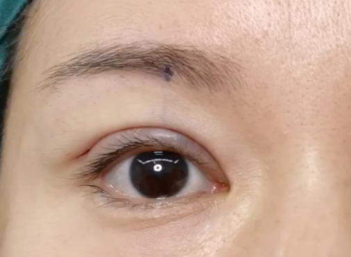 全切雙眼皮會消失嗎？全切雙眼皮多久定型？