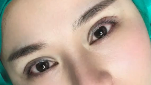全切雙眼皮會消失嗎？