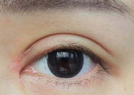 什么是雙眼皮全切？全切雙眼皮拆線多久恢復(fù)？