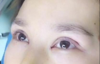 埋線雙眼皮有哪些注意事項(xiàng)？