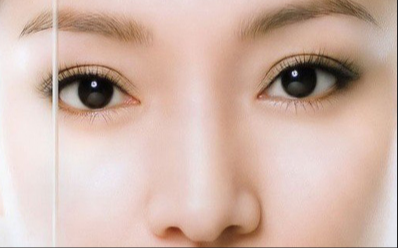 埋線雙眼皮用不用抽脂？雙眼皮埋線眼睛會腫嗎？