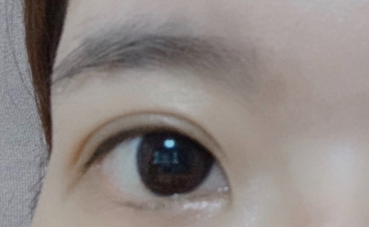 雙眼皮埋線大概多久恢復(fù)？