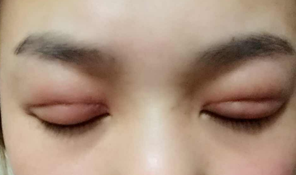 埋線雙眼皮幾天能消腫？