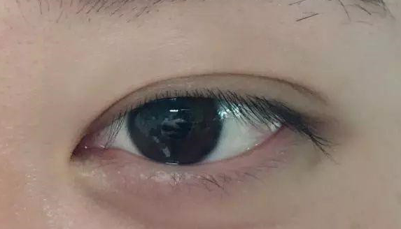 埋線雙眼皮有沒有危害？