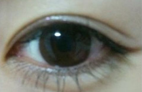 雙眼皮埋線怎么消腫快？埋線雙眼皮手術(shù)后有禁忌嗎？