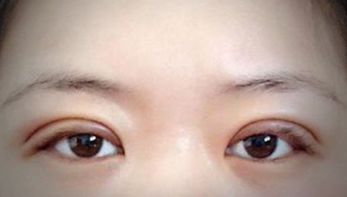 定點(diǎn)雙眼皮幾天能恢復(fù)好？