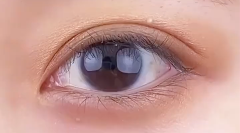 定點雙眼皮多少錢？