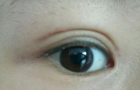 定點雙眼皮是怎么做的？