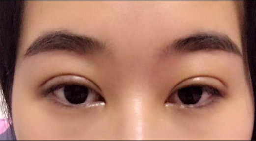 單眼皮割雙眼皮風(fēng)險(xiǎn)大嗎？