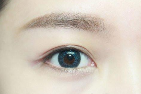 割雙眼皮幾個月定型？