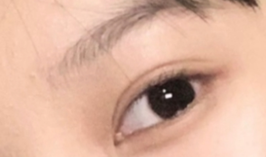 割雙眼皮恢復需要多久？