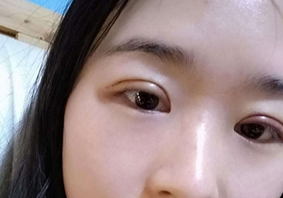 割雙眼皮后眼睛會(huì)變大嗎？