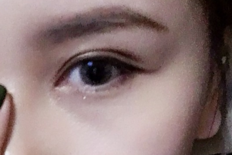 做雙眼皮多久冰敷一次？