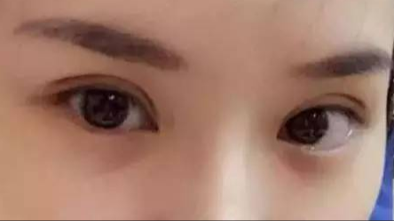 做雙眼皮對身體有沒有危害？