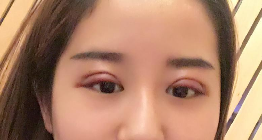 做雙眼皮大概多少錢(qián)？做雙眼皮拆線疼嗎？