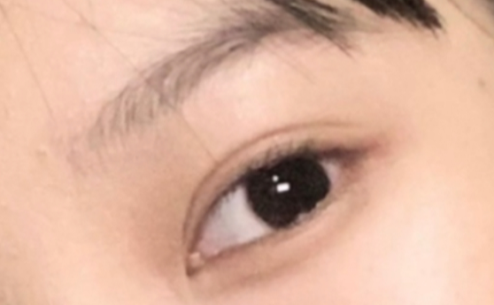 做雙眼皮效果能保持多久？做雙眼皮要冰敷多久？