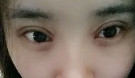 開(kāi)眼角疼嗎？