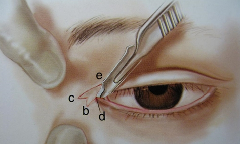 疤痕體質可以割雙眼皮開眼角嗎？能一起做嗎