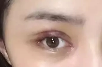 韓式開眼角失敗了怎么辦？