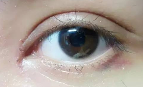 韓式開(kāi)眼角好嗎？韓式開(kāi)眼角術(shù)后怎么護(hù)理？