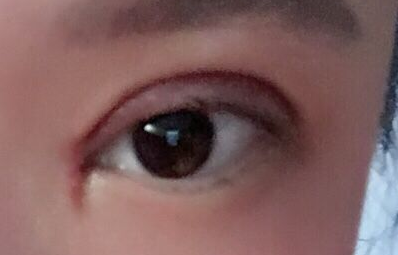 韓式開眼角手術(shù)有哪些優(yōu)勢？