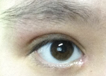 韓式開眼角的效果怎么樣？韓式開眼角失敗了怎么辦？